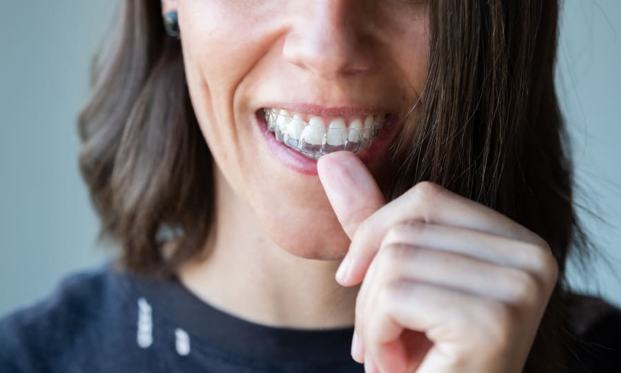 Low-Profile Esthetics of Clear Aligners at Waldman Orthodontics