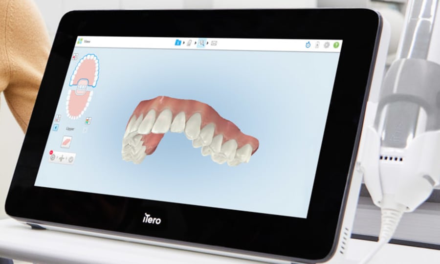 Digital Impressions with iTero for Clear Aligners at Waldman Orthodontics