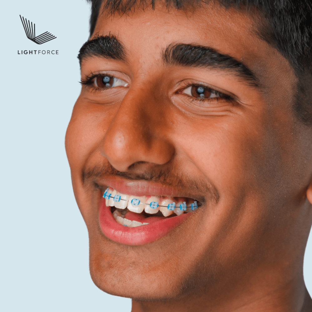 LightForce 3D Printed Braces, Beverly Hills Orthodontist
